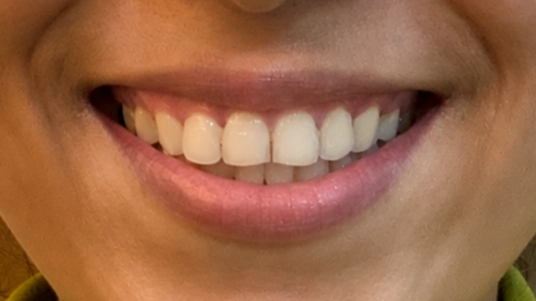 Gummy smile correction - after result