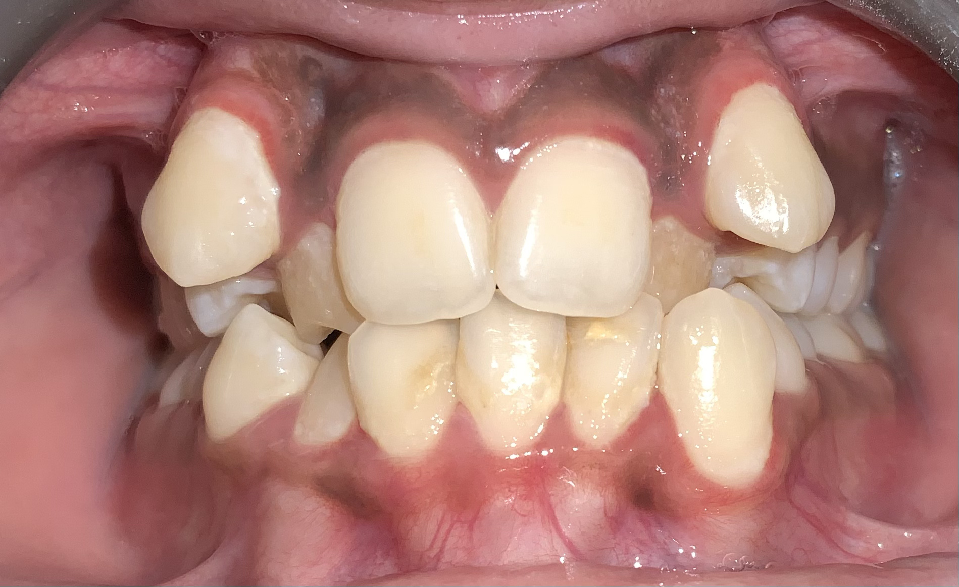Clear aligner treatment - before