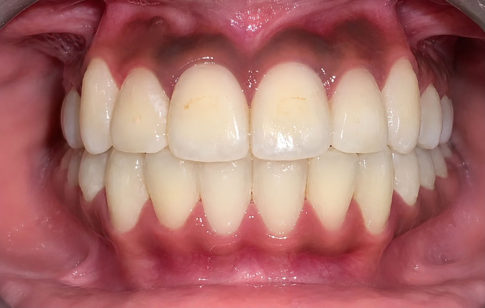 Clear aligner treatment - after result