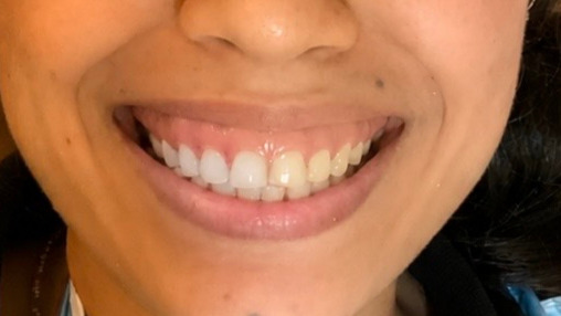 Gummy smile - before treatment
