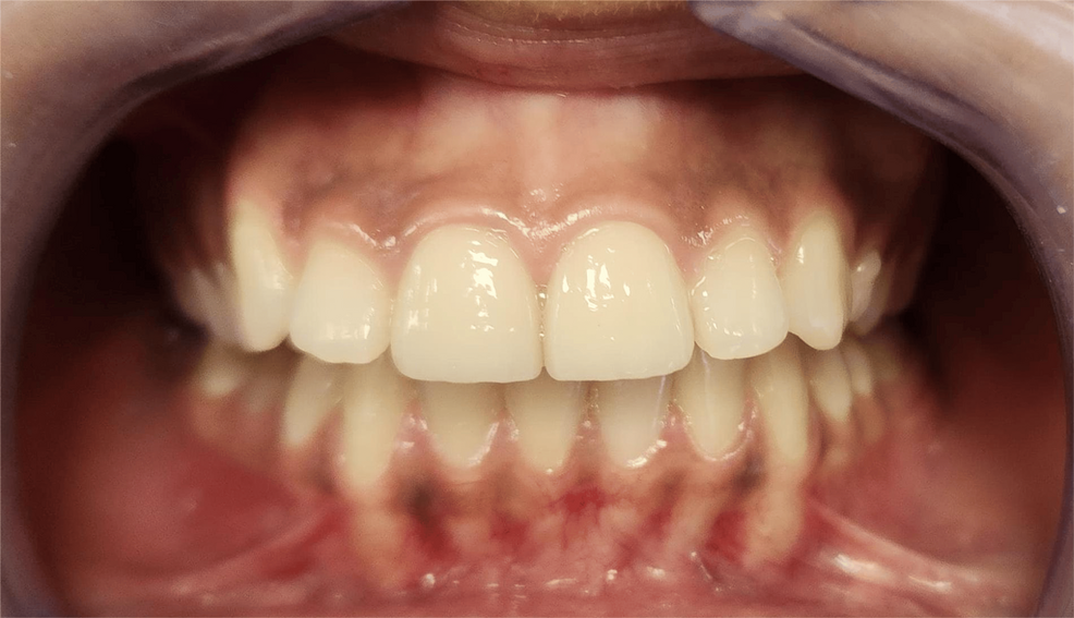 Veneer smile makeover - after result at Smile Masters Dental