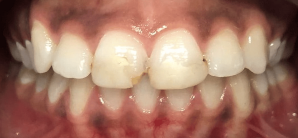 Veneer smile makeover - before